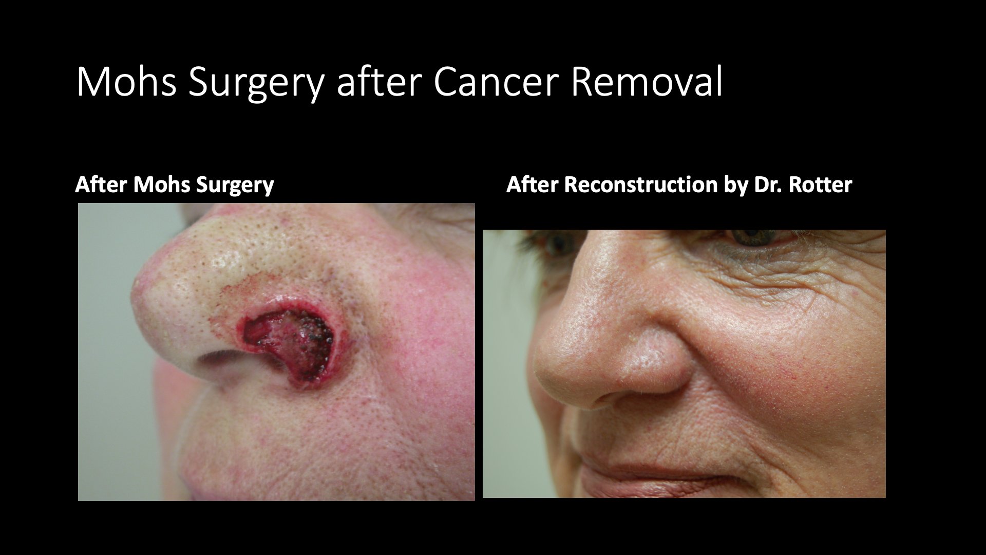 Mohs Surgery After Cancer Removal and Reconstruction