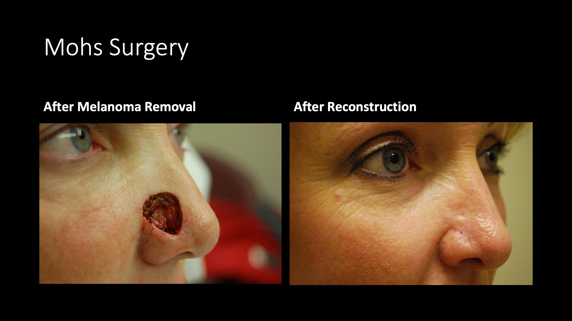 Mohs Surgery — Melanoma Removal and Reconstruction