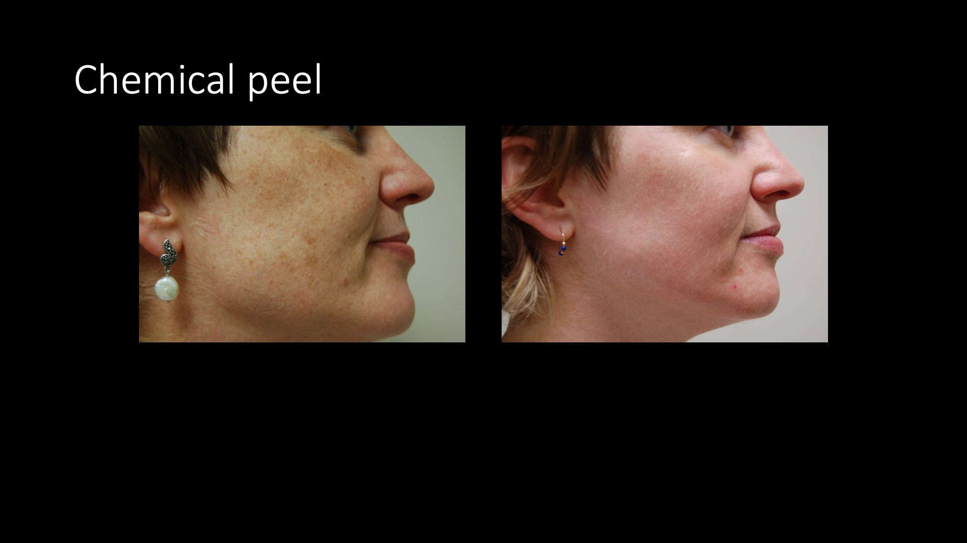 Chemical Peel Before and After — Pigmentation