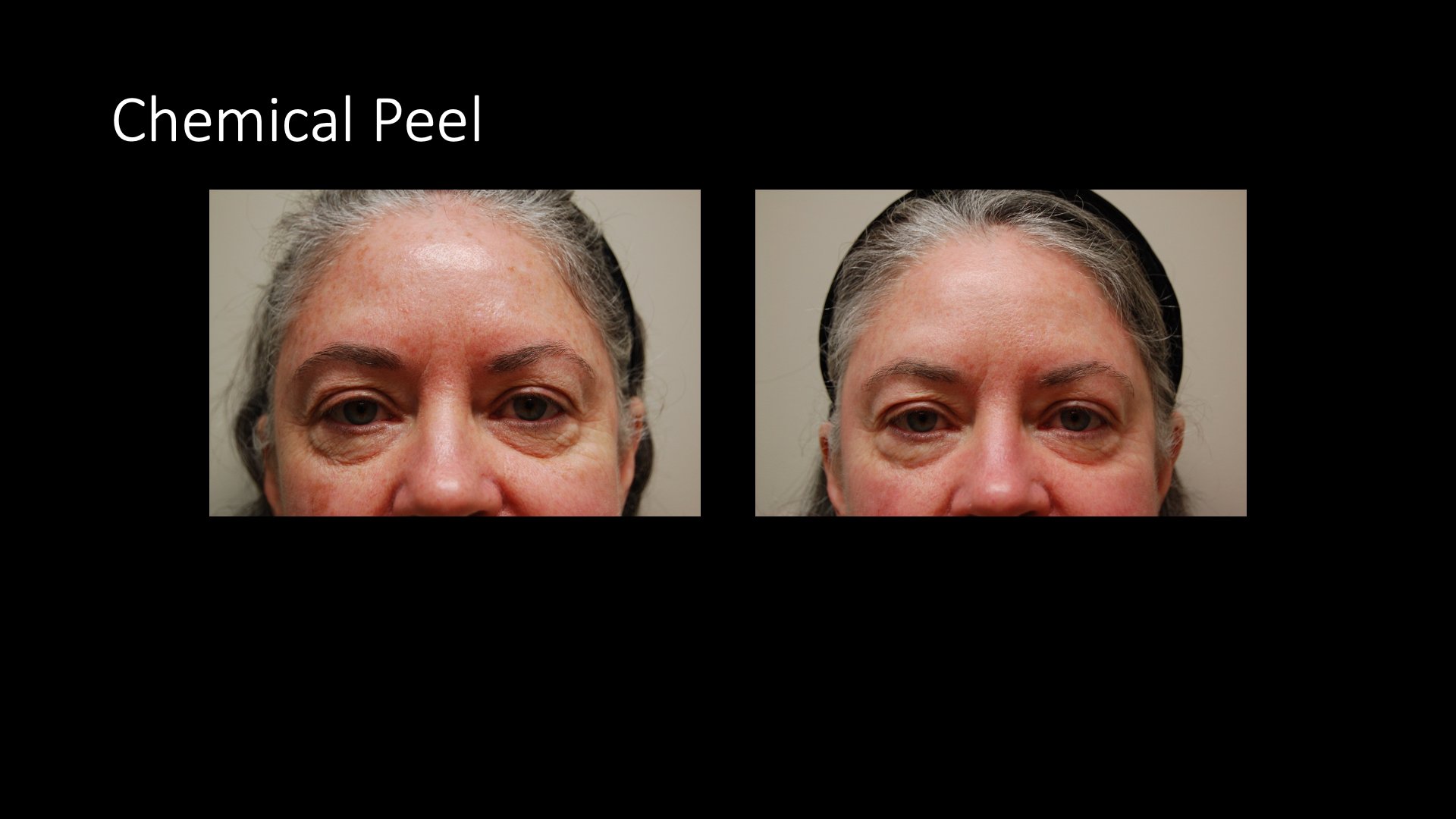 Chemical Peel Before and After — Eye Area