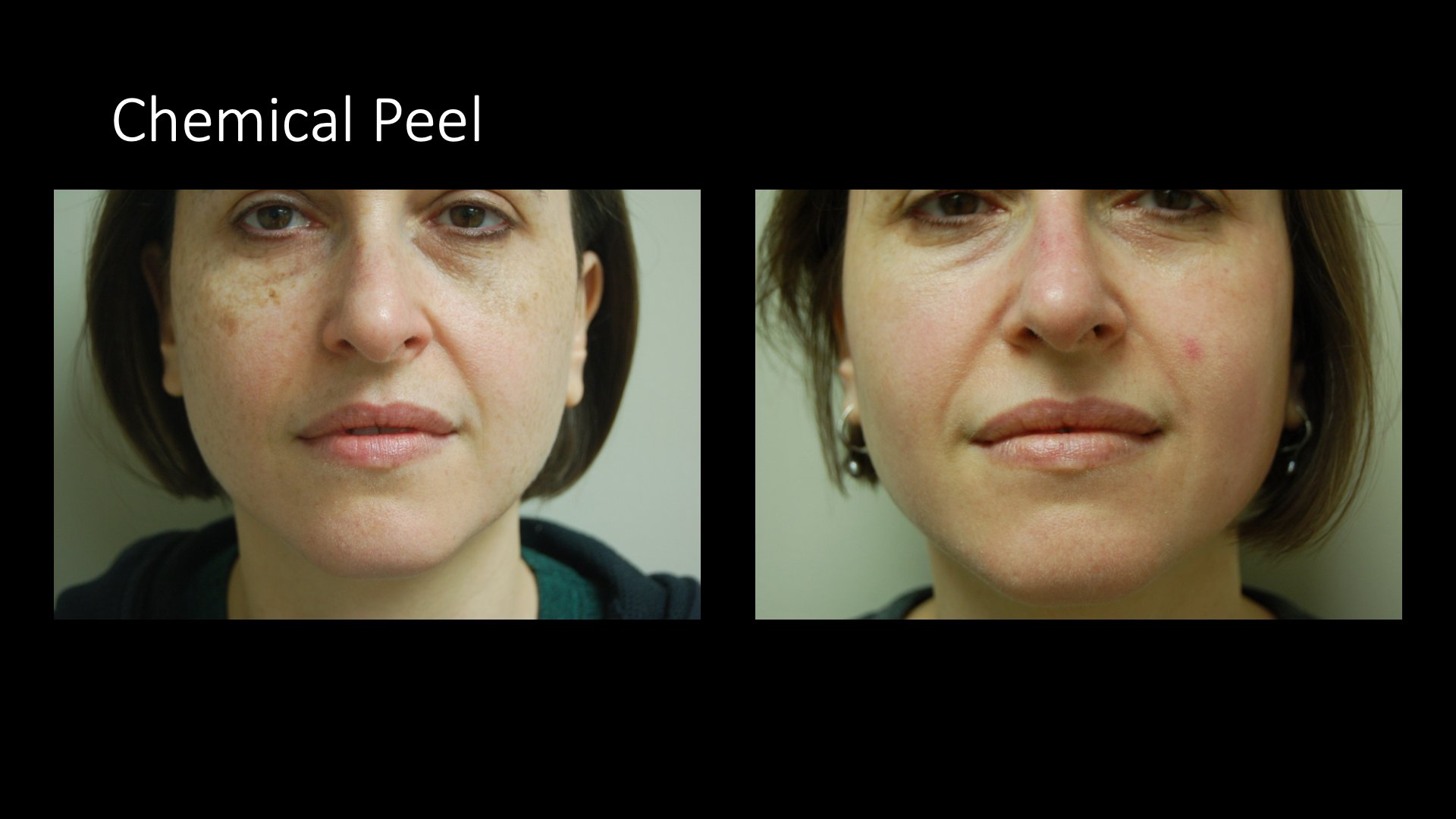 Chemical Peel Before and After — Facial Pigmentation