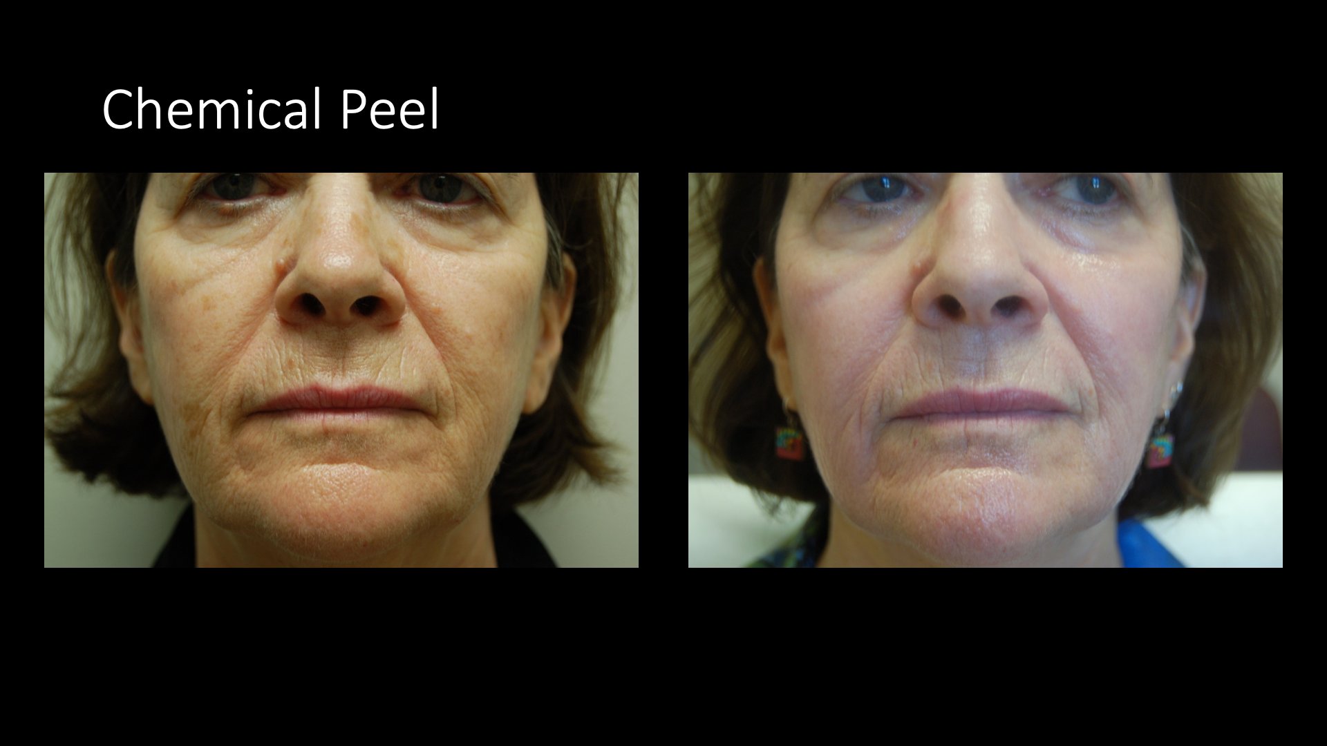 Chemical Peel Before and After — Full Face Wrinkles