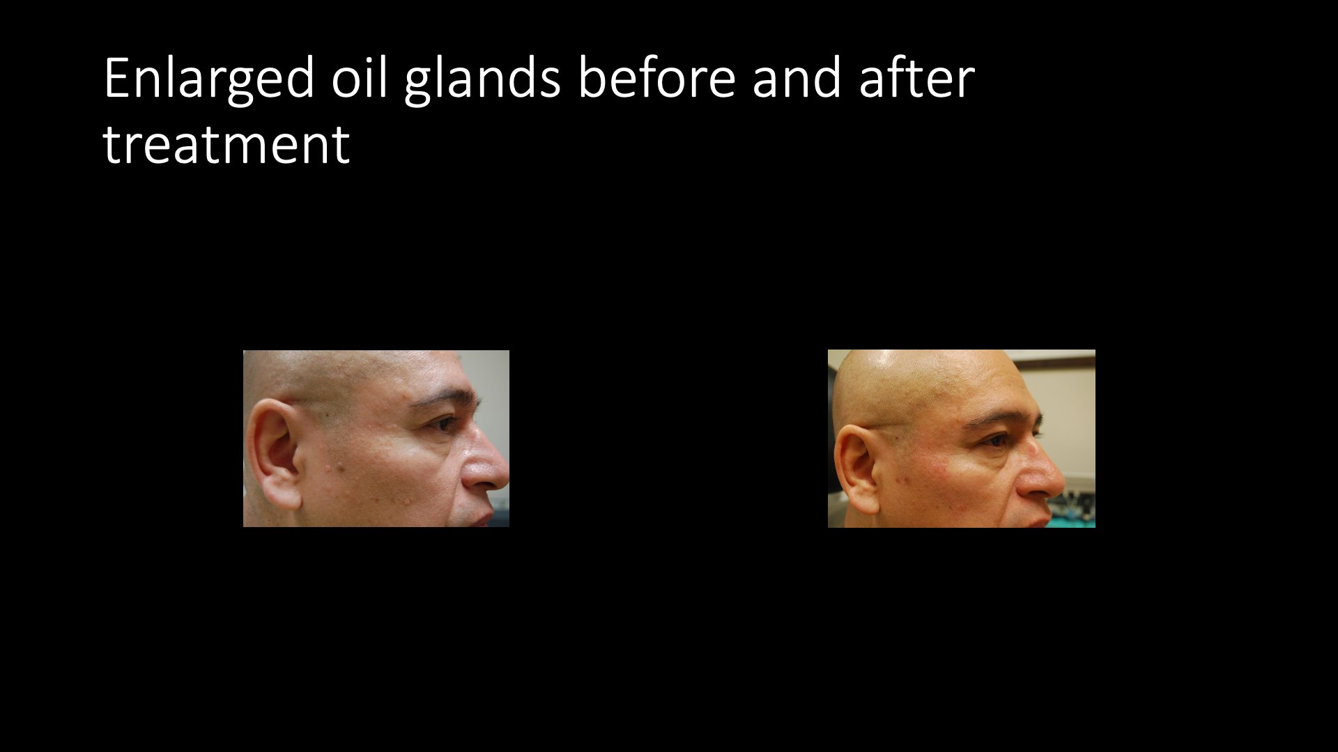 Enlarged Oil Glands Before and After Treatment