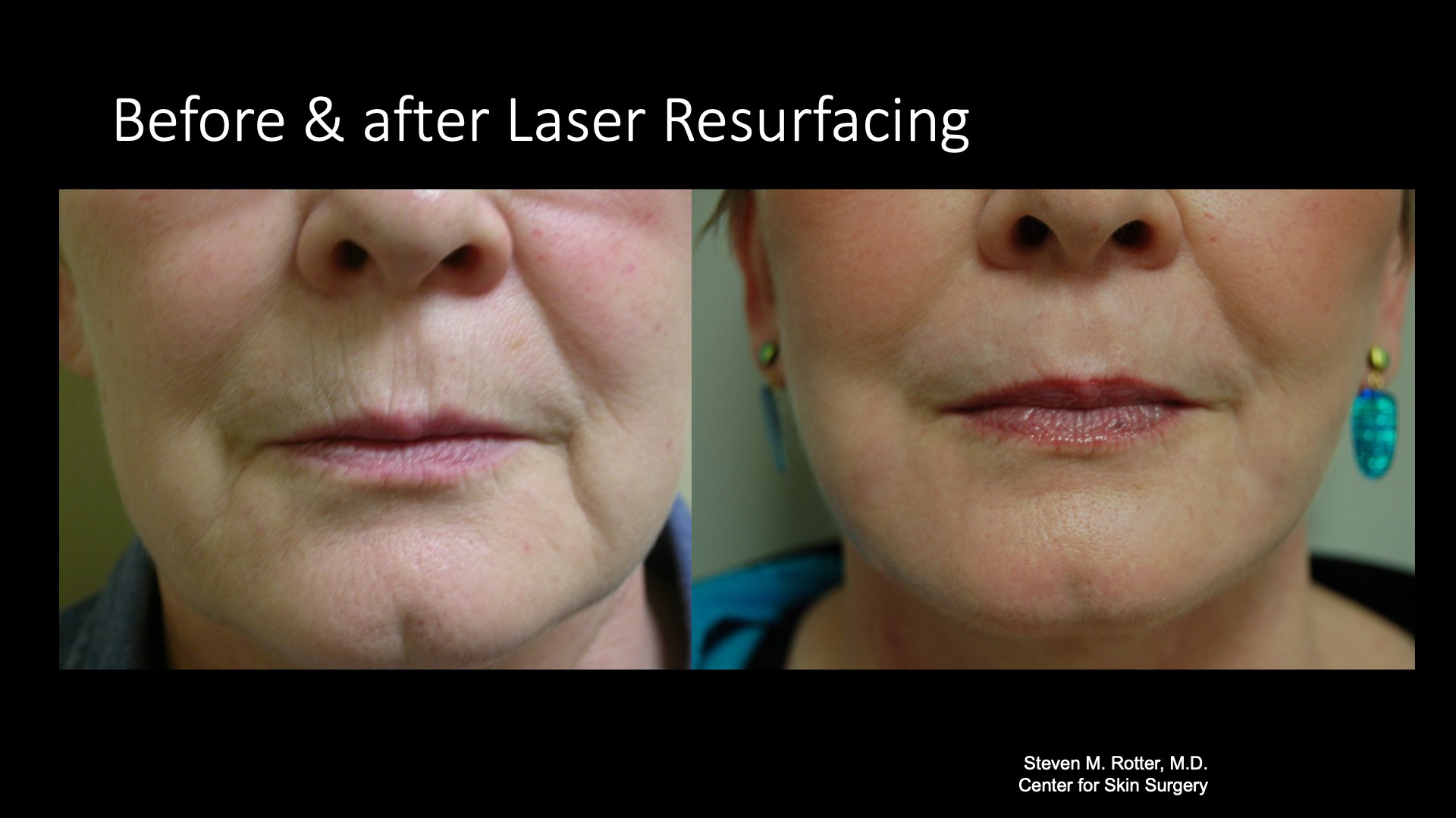 Before and After Laser Resurfacing — Perioral