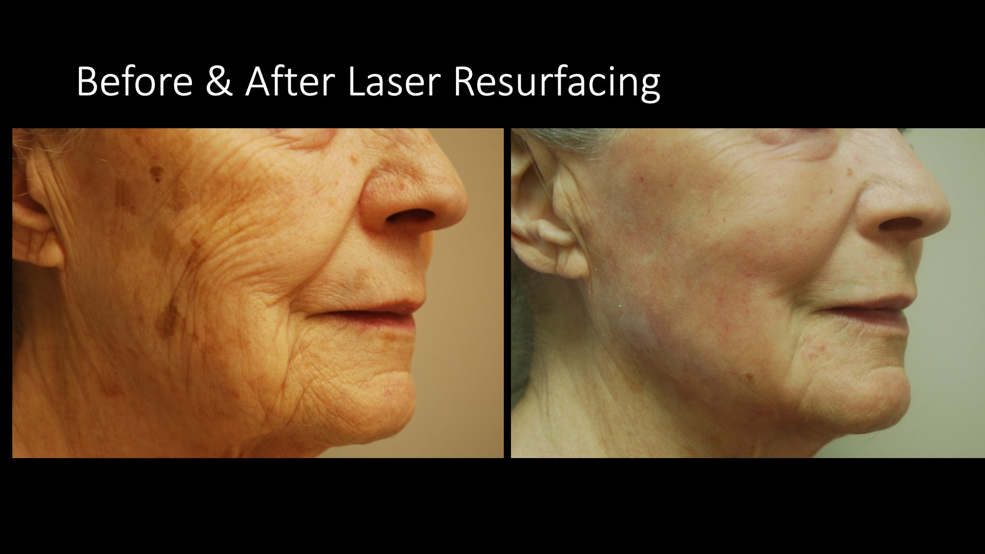 Before and After Laser Resurfacing — Full Face