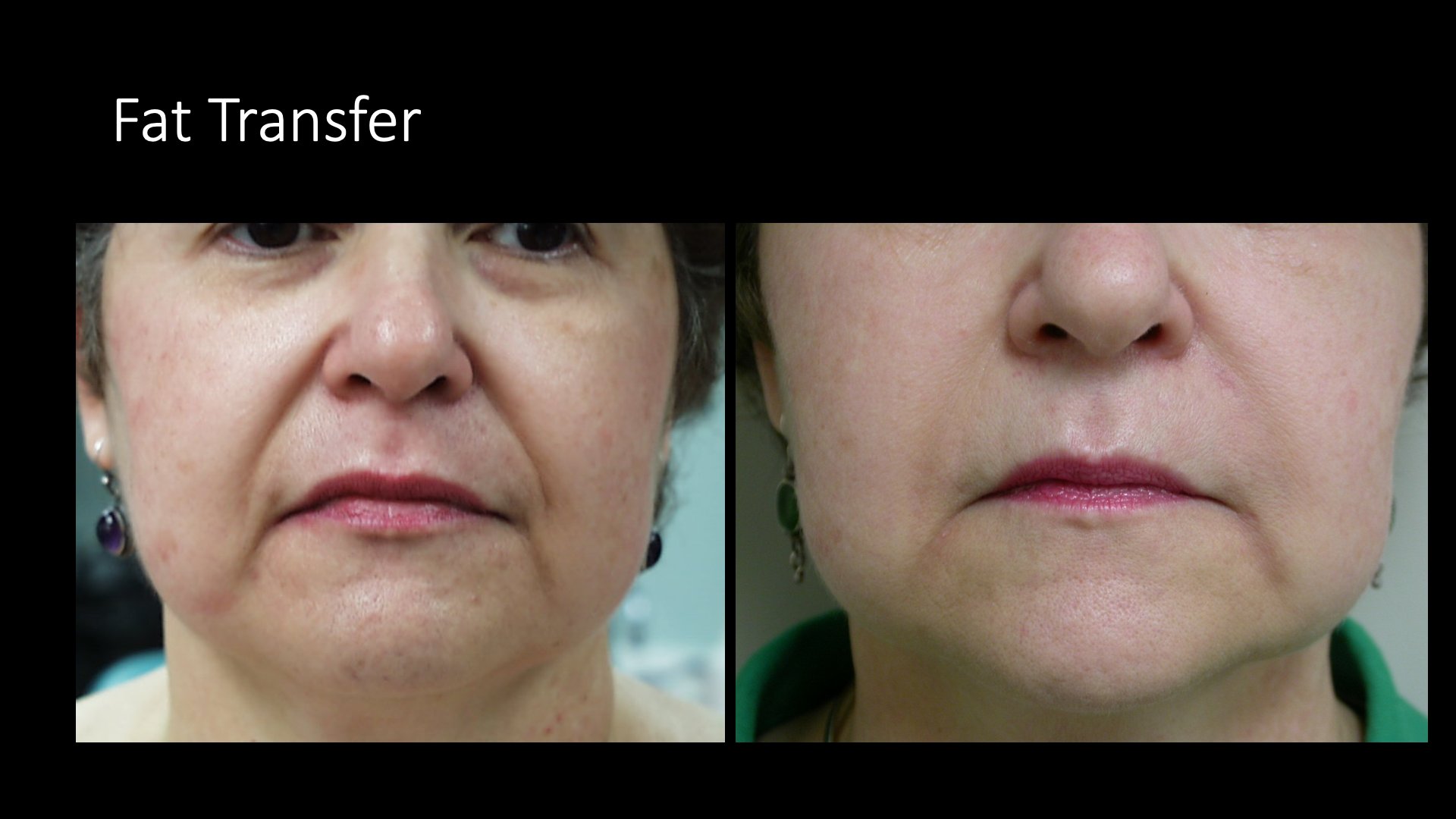 Fat Transfer Before and After