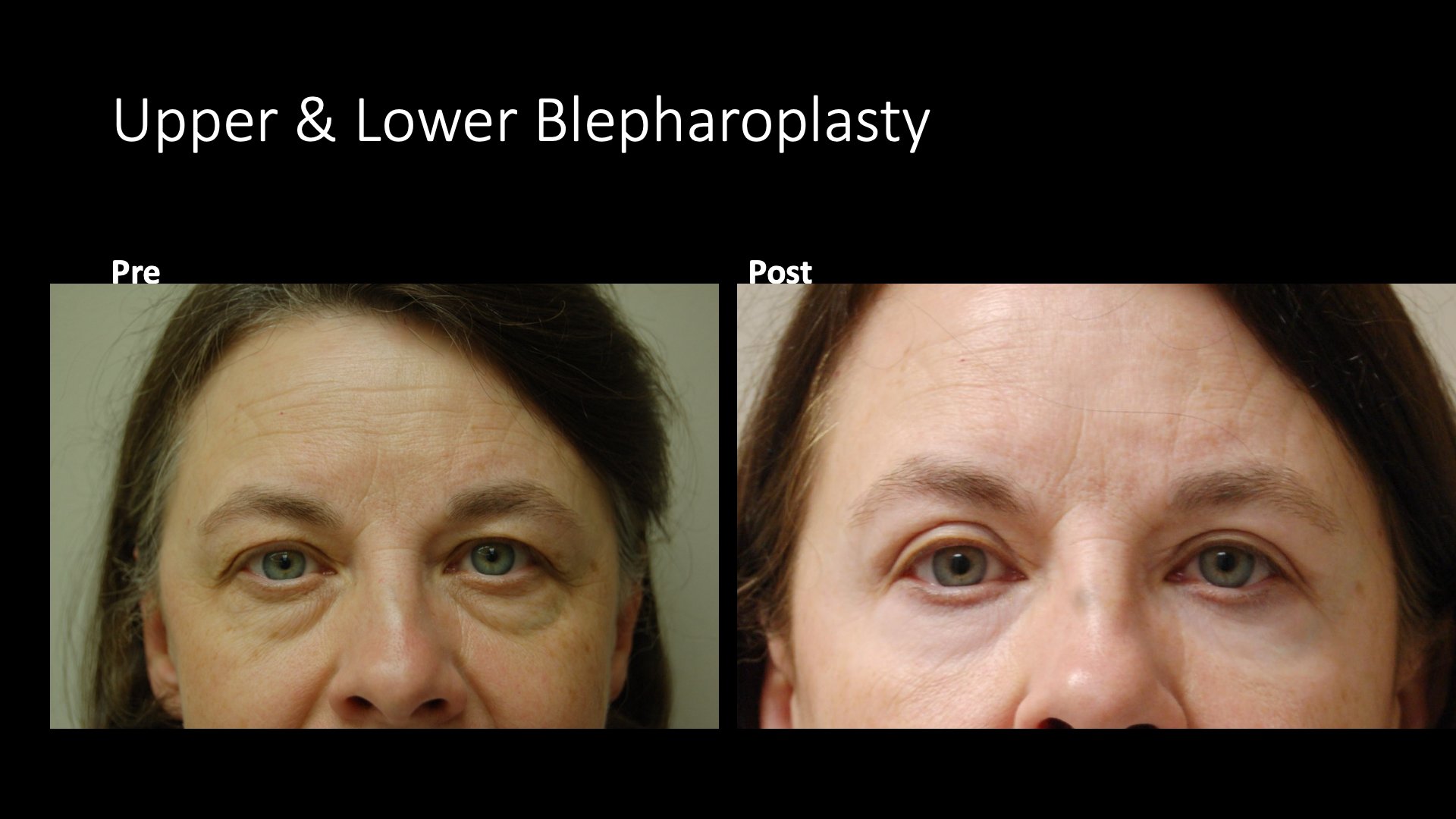 Upper and Lower Blepharoplasty Before and After