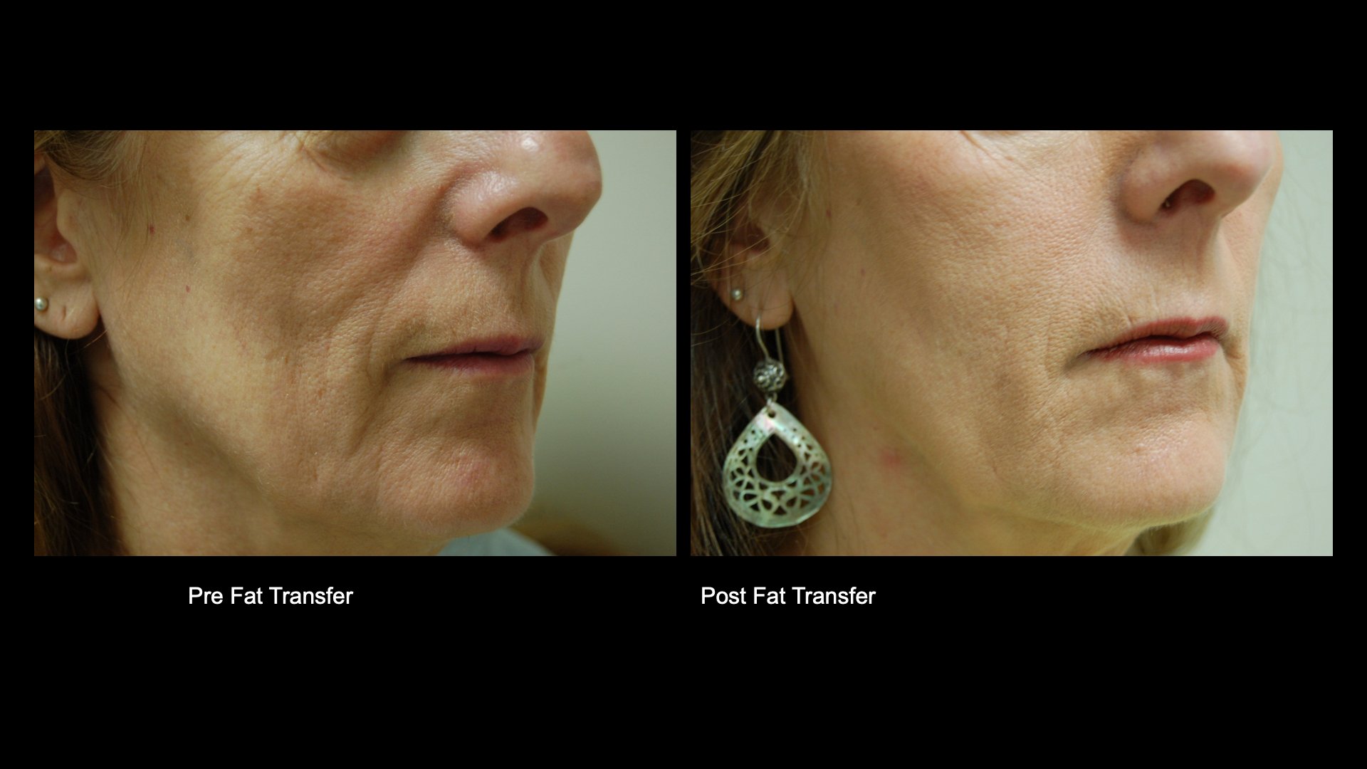 Fat Transfer Pre and Post