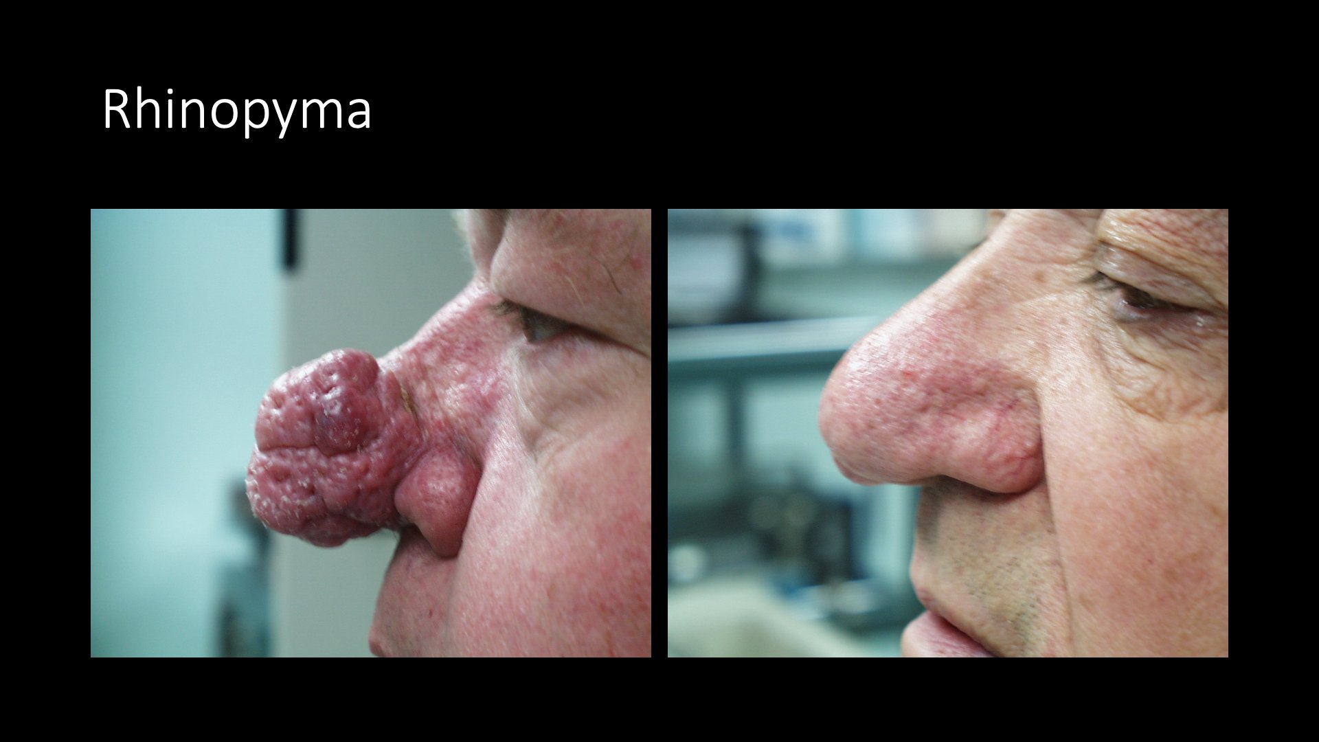 Rhinophyma Before and After