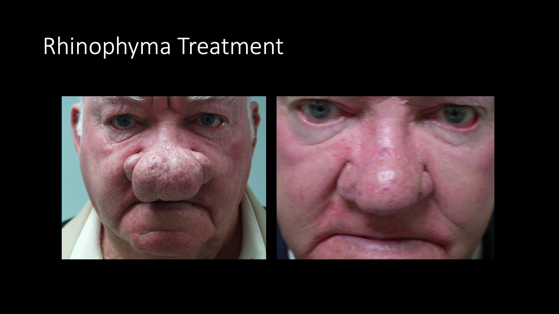 Rhinophyma Treatment Before and After