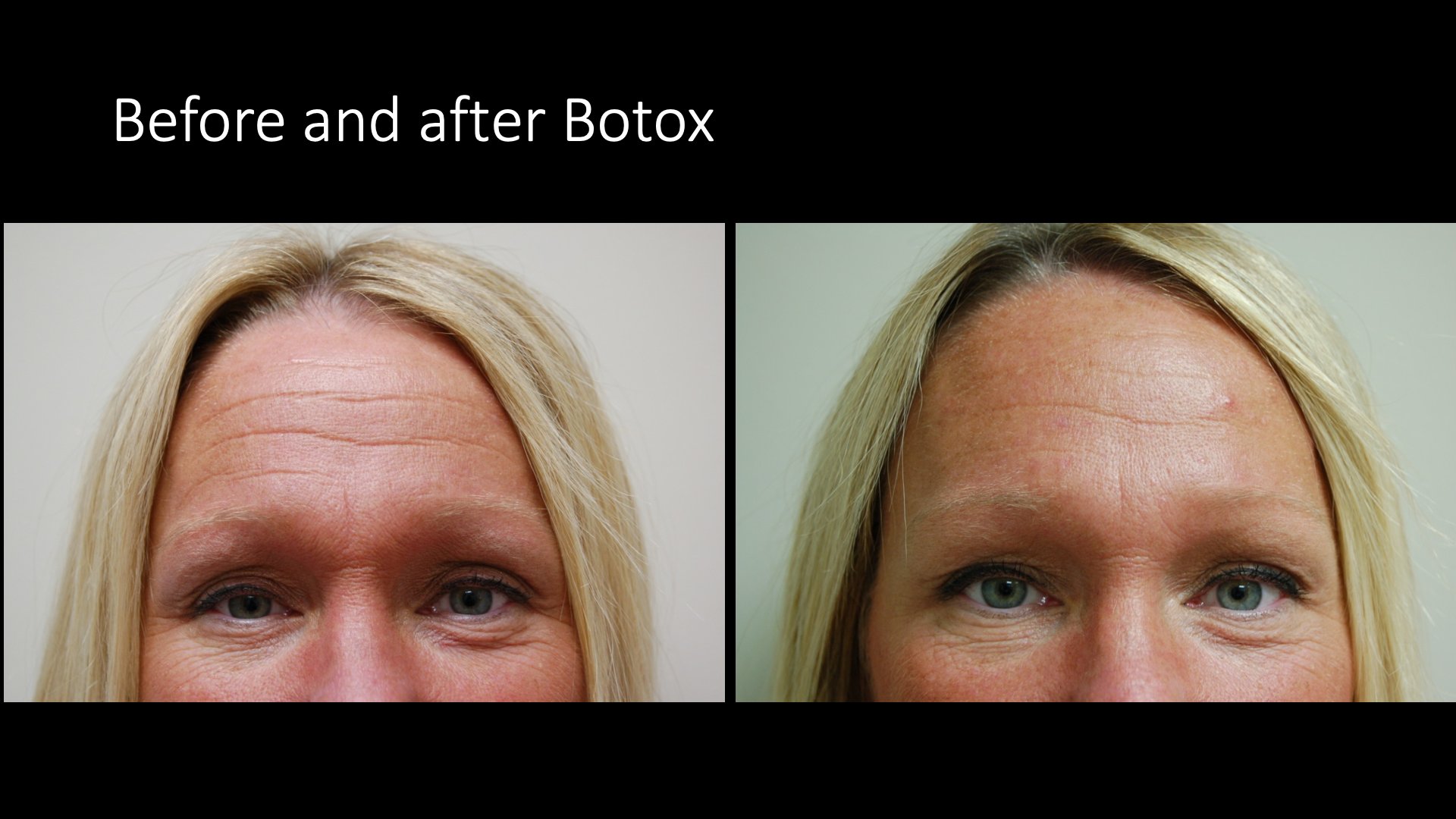 Before and after Botox — Exclusive Dermatology West Palm Beach
