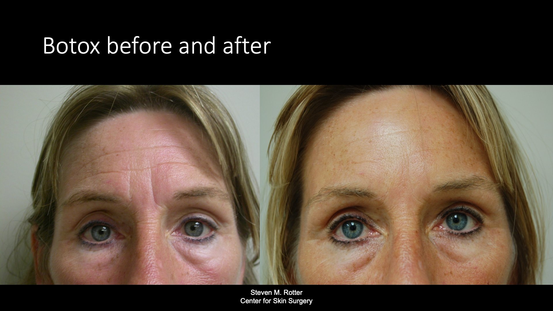 Botox before and after — Dr. Steven Rotter