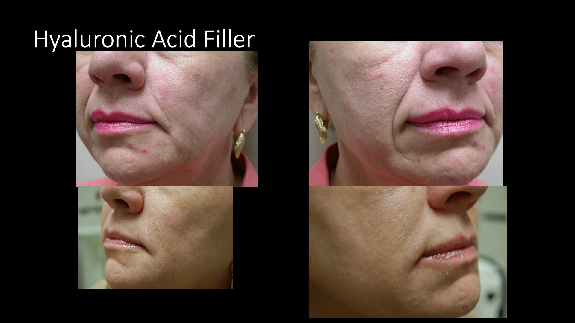 Hyaluronic Acid Filler Before and After — Facial Volume