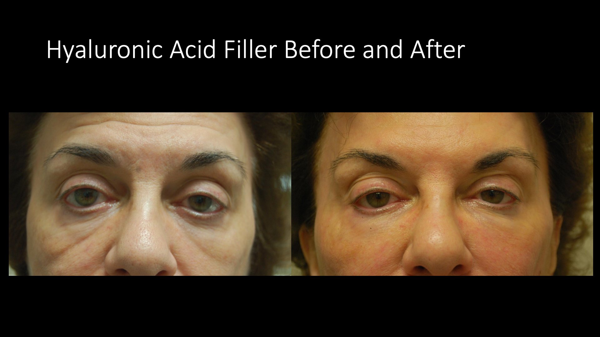 Hyaluronic Acid Filler Before and After — Brow Area