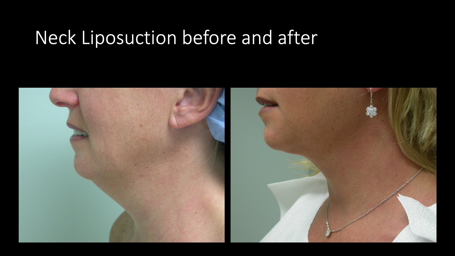 Neck Liposuction Before and After