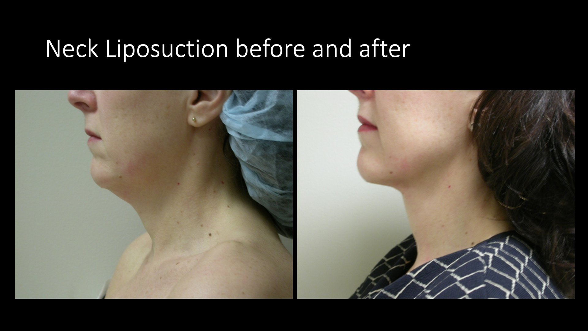Neck Liposuction Before and After