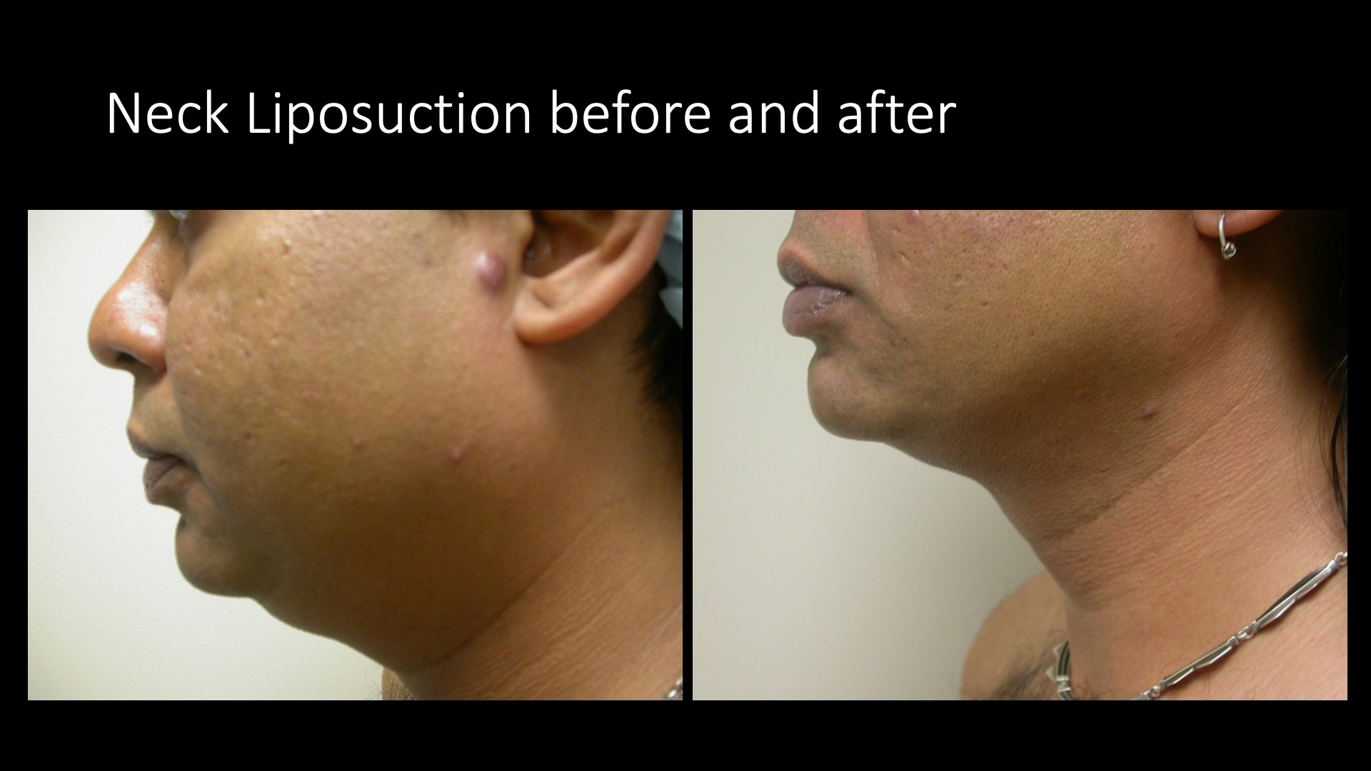 Neck Liposuction Before and After