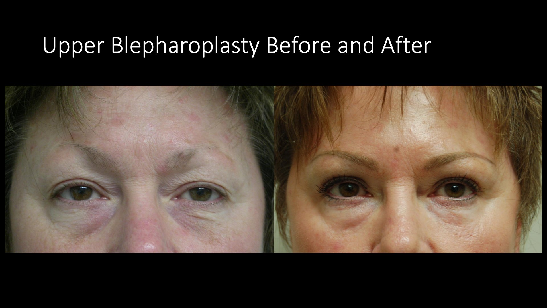 Upper Blepharoplasty Before and After
