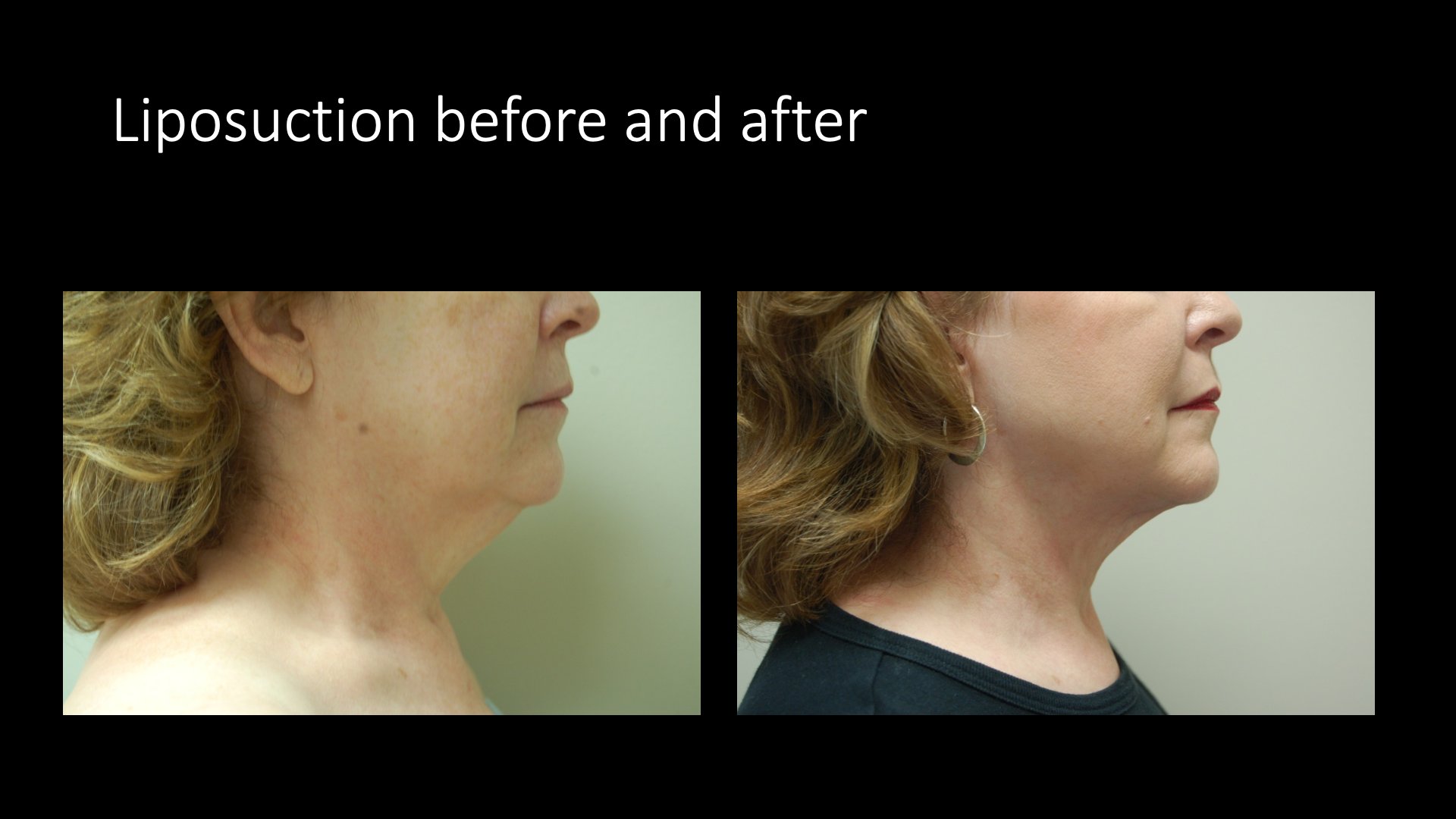 Liposuction Before and After