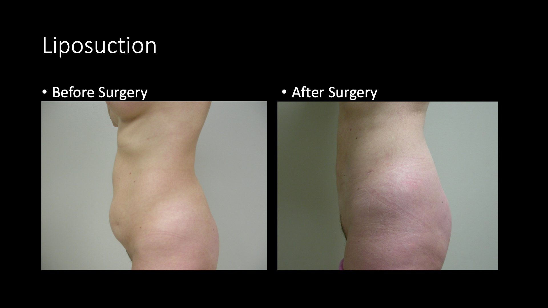 Liposuction Body Before and After