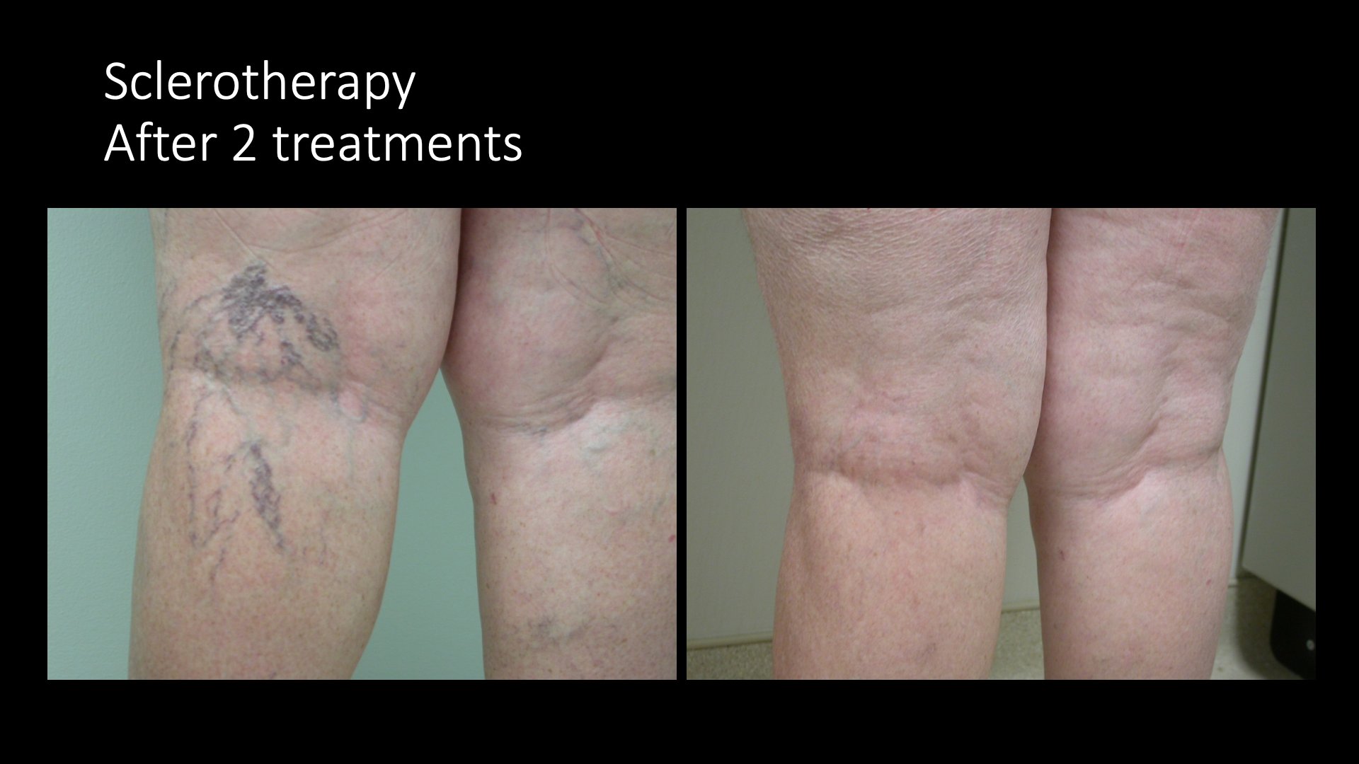 Sclerotherapy Before and After — After 2 Treatments