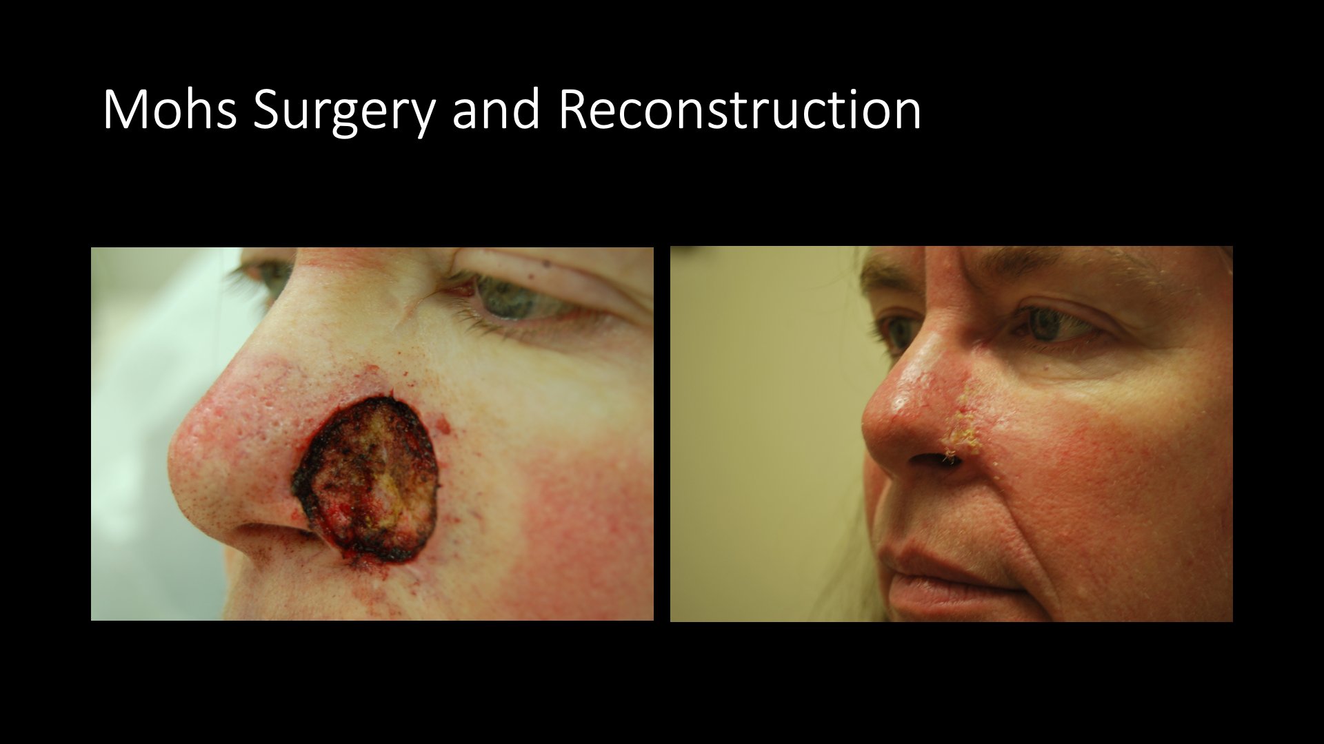 Mohs Surgery and Reconstruction — Nose