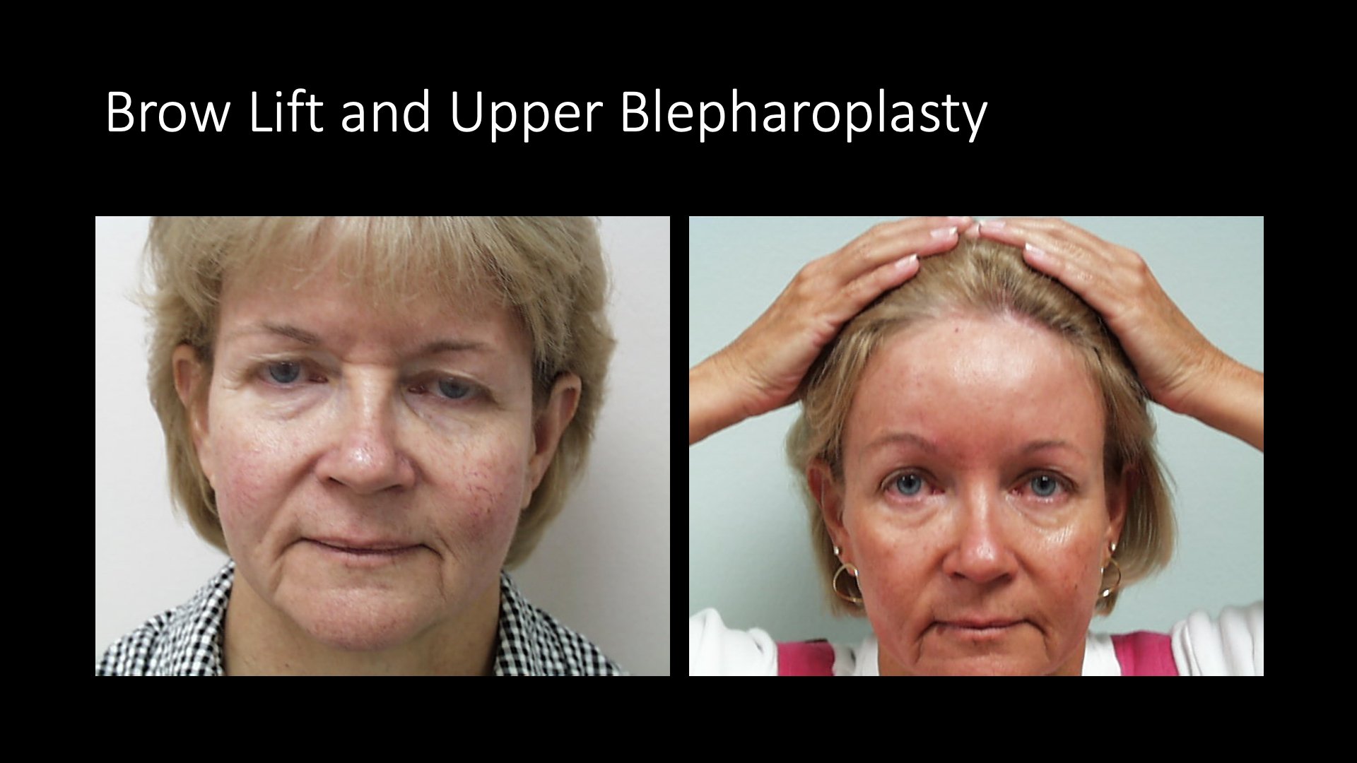Brow Lift and Upper Blepharoplasty Before and After