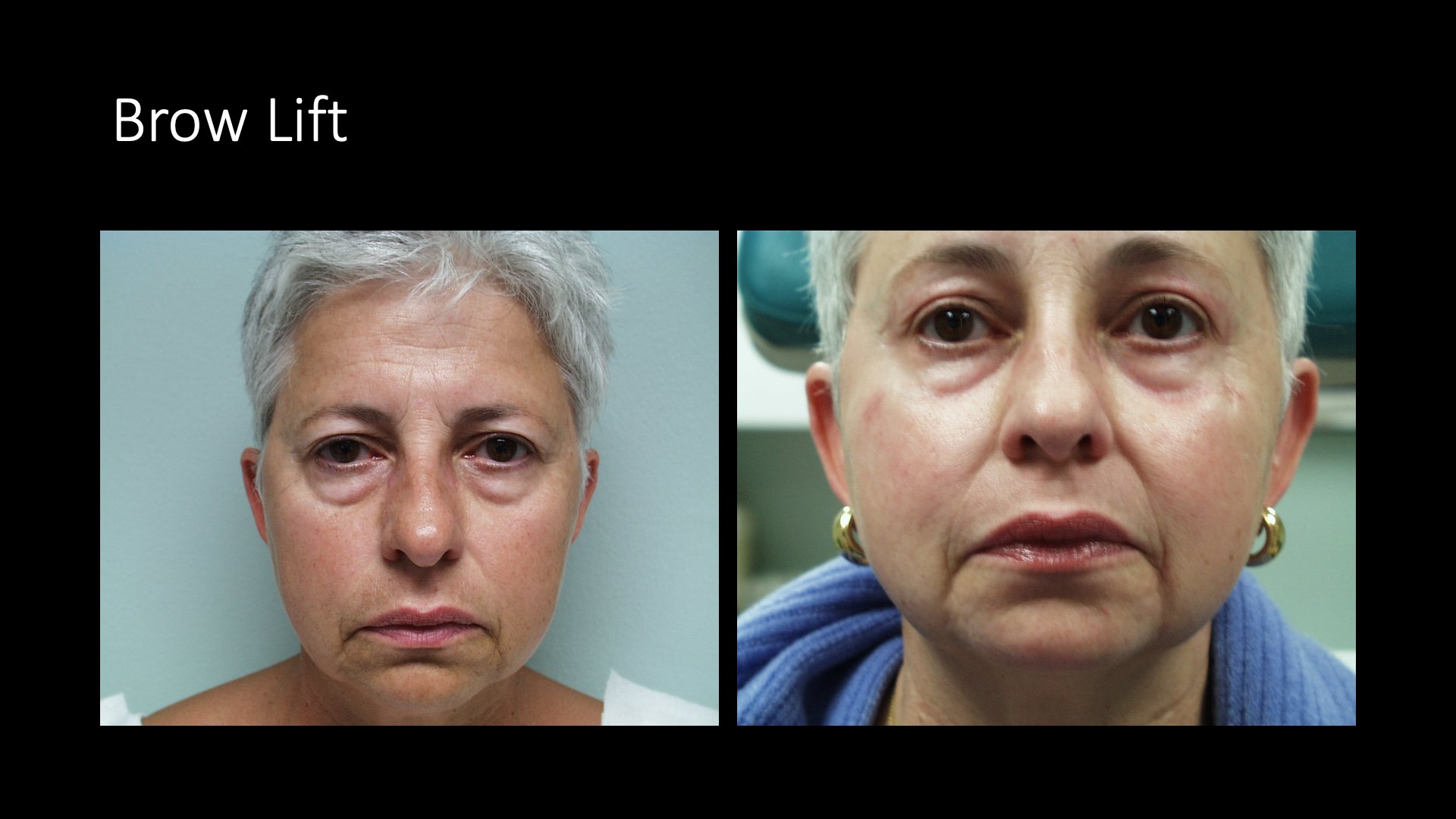 Brow Lift Before and After