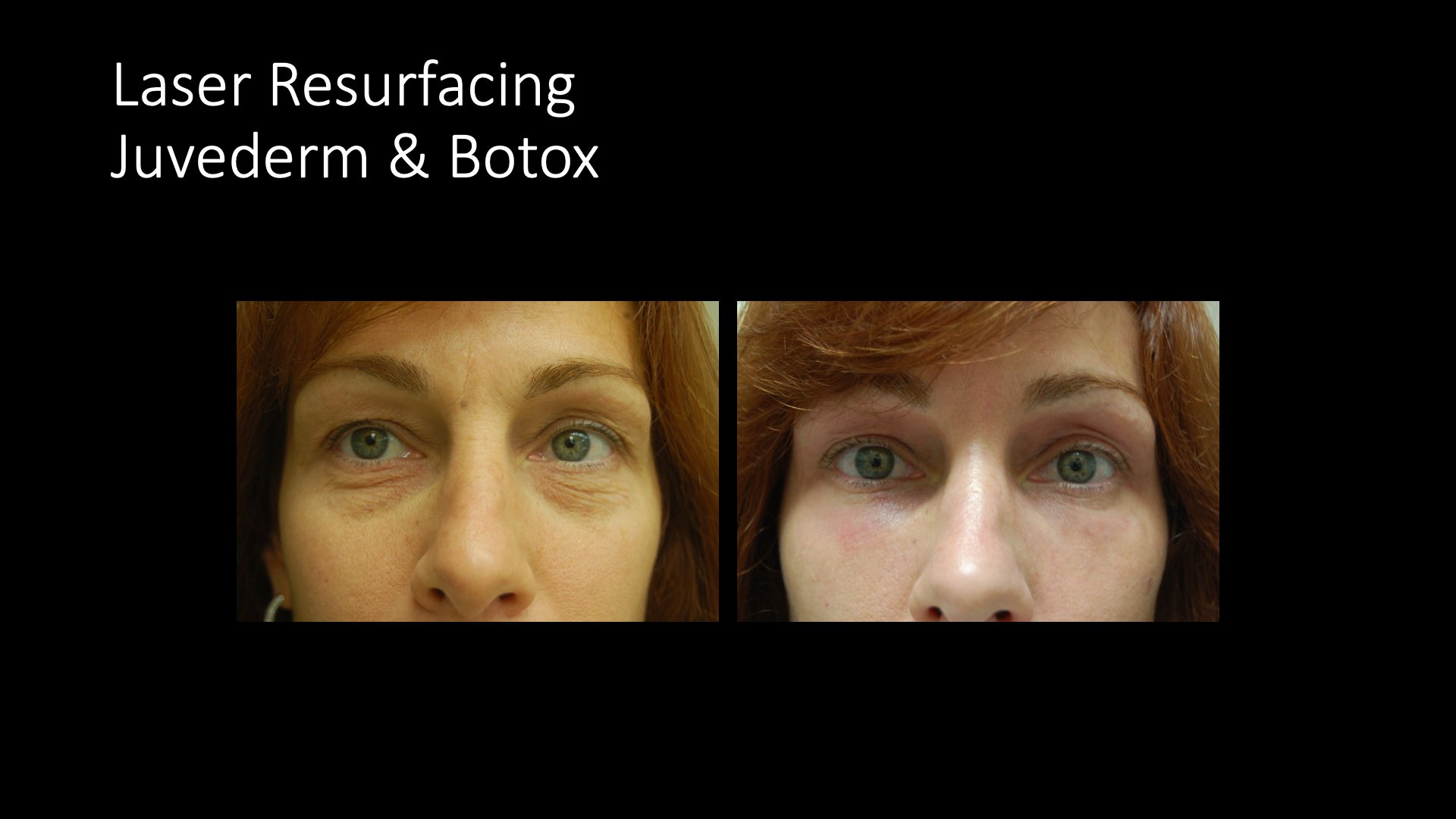 Laser Resurfacing, Juvederm and Botox