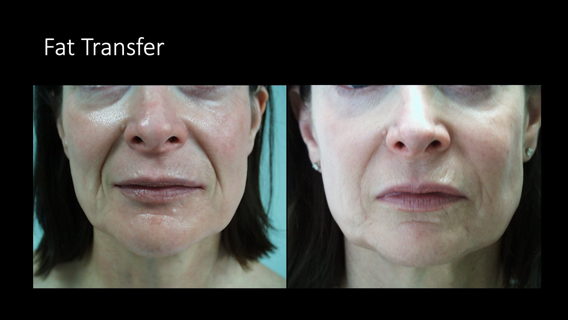 Fat Transfer Before and After