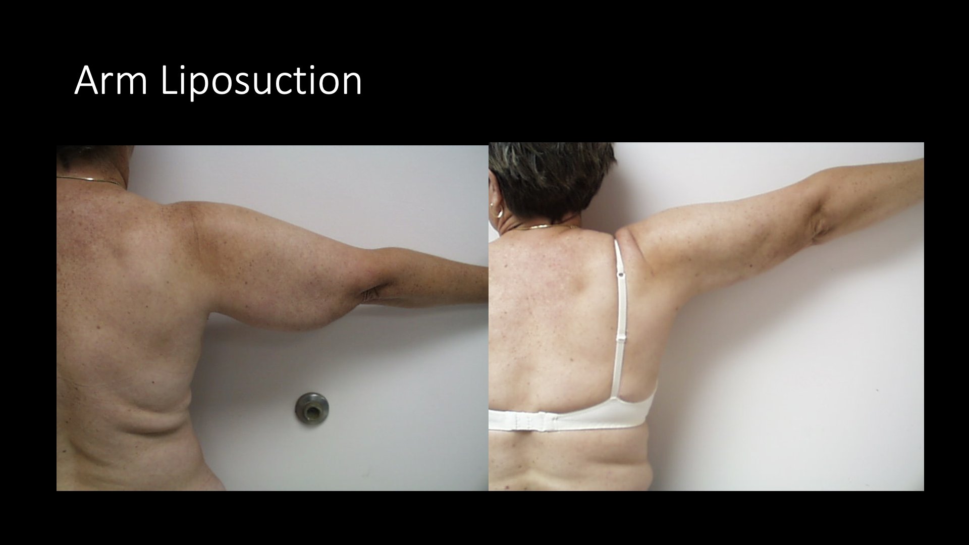 Arm Liposuction Before and After