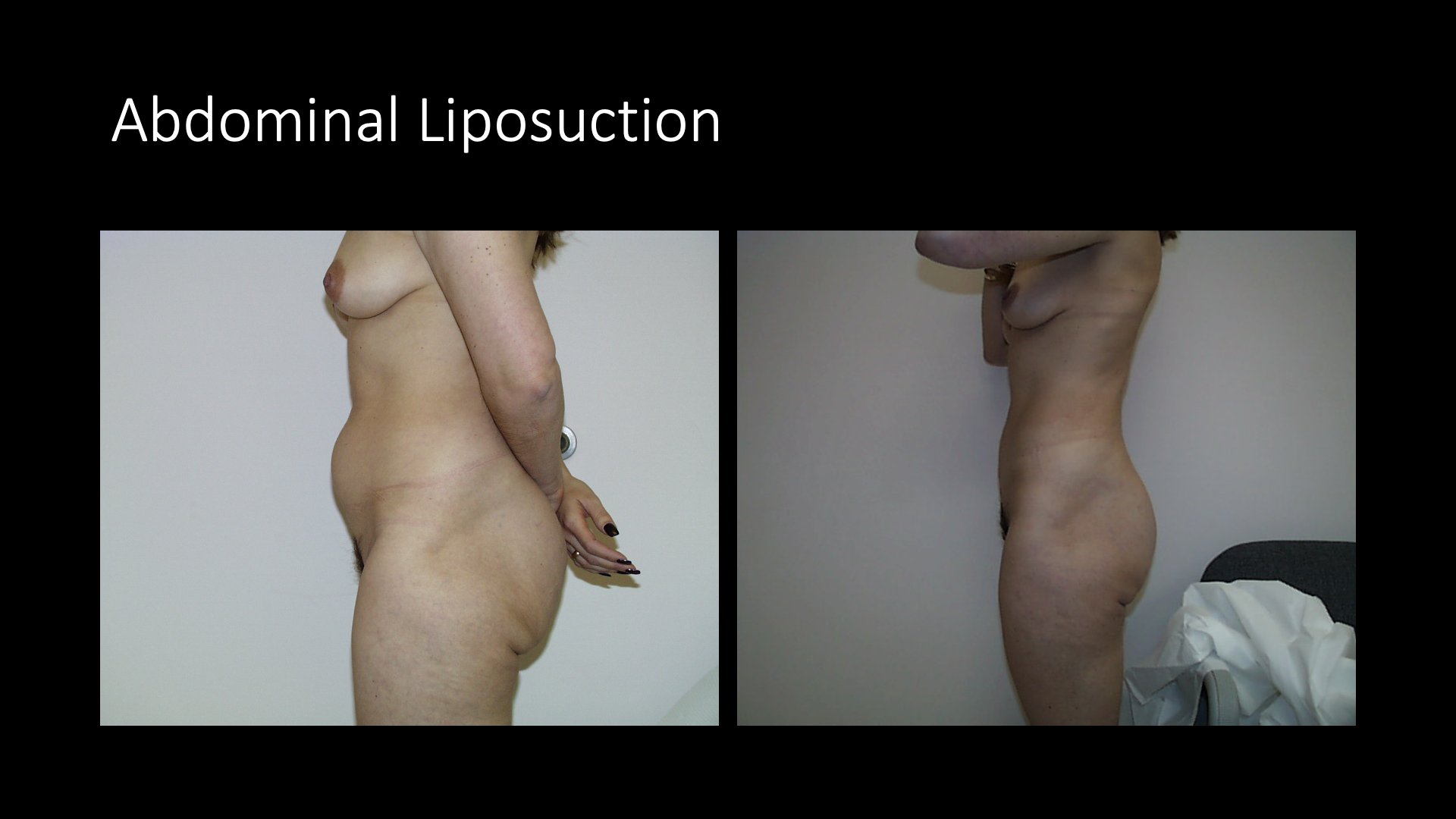 Abdominal Liposuction Before and After