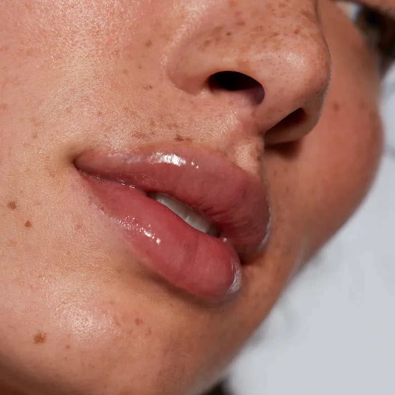 Dermal Fillers Juvederm West Palm Beach