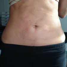 Tumescent Liposuction West Palm Beach