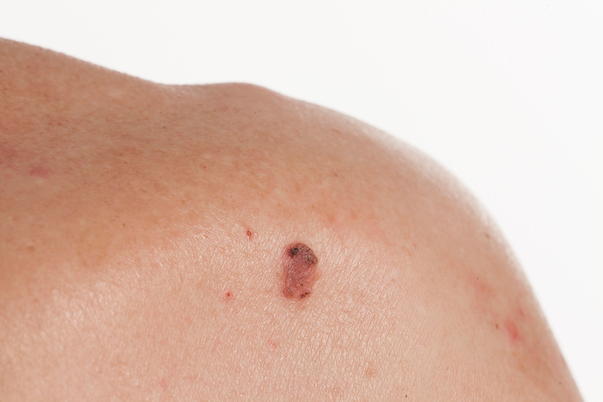 Skin Cancer Treatment West Palm Beach
