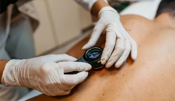 Full Body Skin Exams West Palm Beach